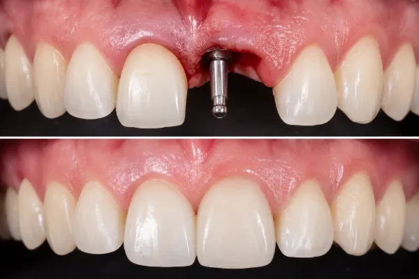 Publication image: Role of monobloc dental implants in the rehabilitation of anterior dentoalveolar trauma